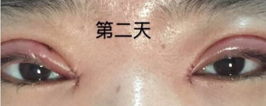秦皇岛做的双眼皮右眼角肿了一块怎么回事?
