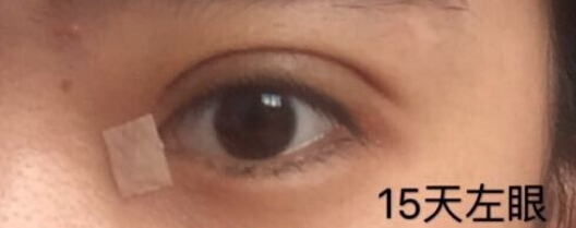秦皇岛做的双眼皮右眼角肿了一块怎么回事?