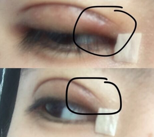 秦皇岛做的双眼皮右眼角肿了一块怎么回事?