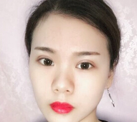 李芸医生做的双眼皮,问一下鼻子怎么做?