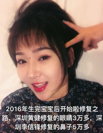 深圳美立达做的双眼皮修复和鼻部手术手术