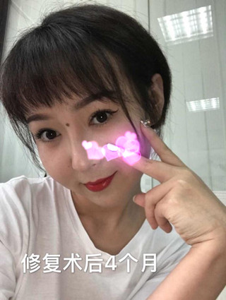 深圳美立达做的双眼皮修复和鼻部手术手术