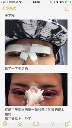 西京医院刘超华做双眼皮开眼角怎么样?