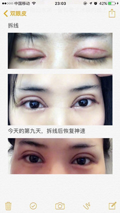 西京医院刘超华做双眼皮开眼角怎么样?