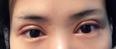 西京医院刘超华做双眼皮开眼角怎么样?