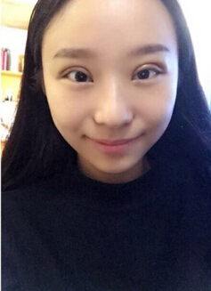 郑州都市风韵美容门诊做双眼皮开眼角果
