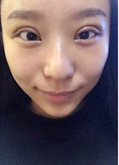 郑州都市风韵美容门诊做双眼皮开眼角果
