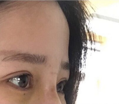 浙江一个市人民医院做的硅胶鼻部手术