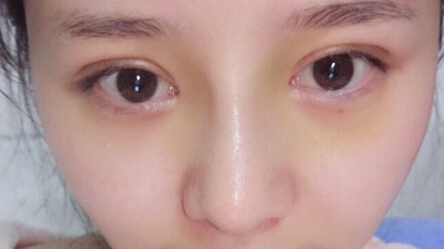 浙江一个市人民医院做的硅胶鼻部手术