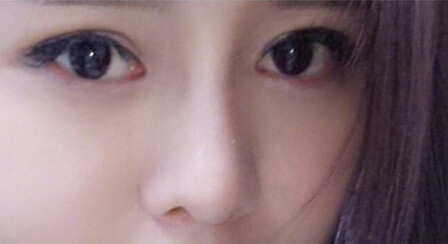 浙江一个市人民医院做的硅胶鼻部手术