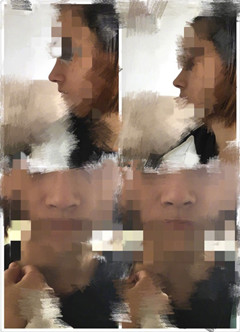 大家做了鼻部手术后有没有露鼻孔？
