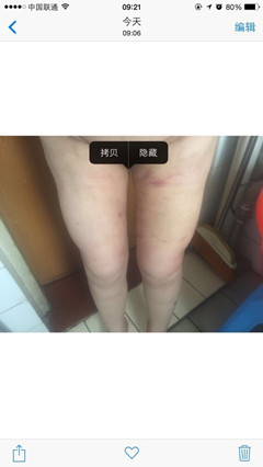 成都艾米丽刘叔阳做的大腿吸脂手术果