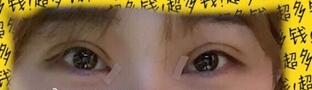 沈阳陆军总院做的双眼皮开眼角手术