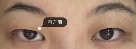 上海九院毕晓萍医生做的双眼皮去皮去脂