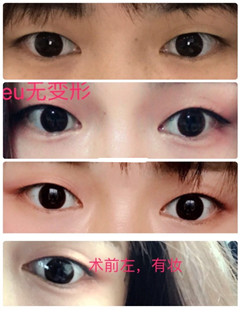帮我看看崔永言做的双眼皮线条和宽度如何?