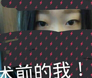 广州军美医院王高峰医生做的全切双眼皮