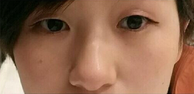 杭州优医联合医美周其光做双眼皮开眼角果