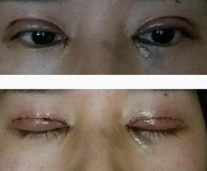杭州优医联合医美周其光做双眼皮开眼角果