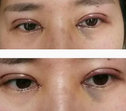 杭州优医联合医美周其光做双眼皮开眼角果
