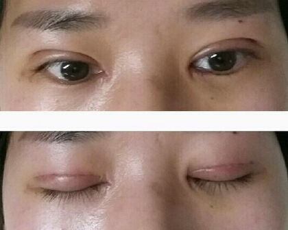 杭州优医联合医美周其光做双眼皮开眼角果