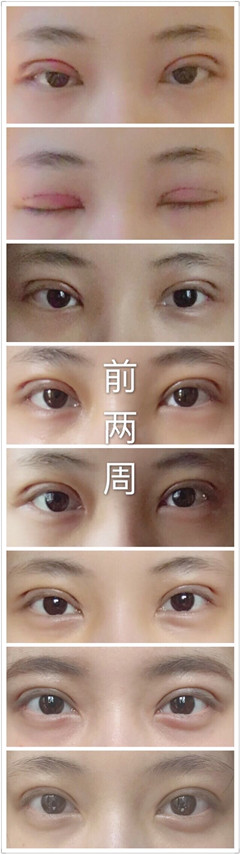 上海九院朱海男医生做的全切双眼皮手术果