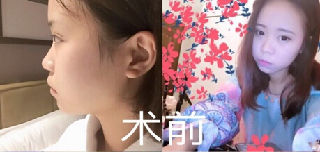 西南医院毕胜医生做的硅胶鼻部手术手术