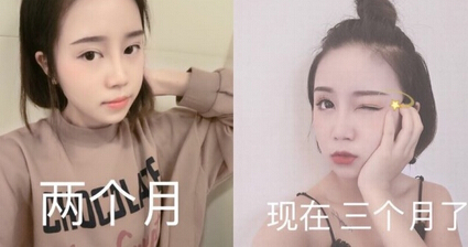西南医院毕胜医生做的硅胶鼻部手术手术