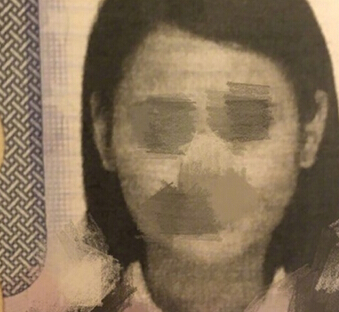 拔智齿、注射瘦脸、下巴,对脸型的改良大吗?