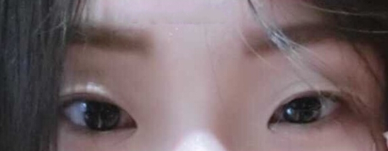 南京华美江宝华价格两万七做的眼部手术手术