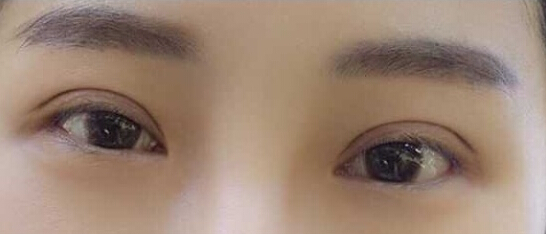 南京华美江宝华价格两万七做的眼部手术手术