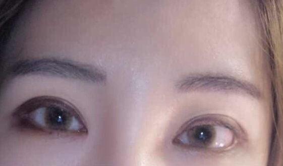南京华美江宝华价格两万七做的眼部手术手术