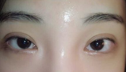 南京华美江宝华价格两万七做的眼部手术手术
