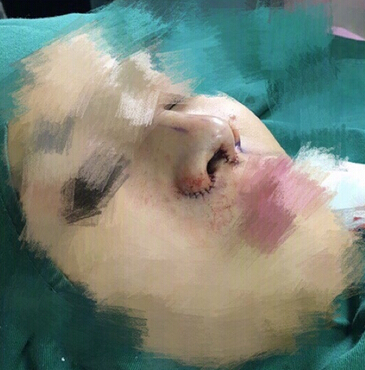 工作室做的耳软骨垫鼻尖,假体隆鼻和鼻翼缩小