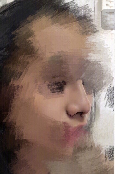 工作室做的耳软骨垫鼻尖,假体隆鼻和鼻翼缩小