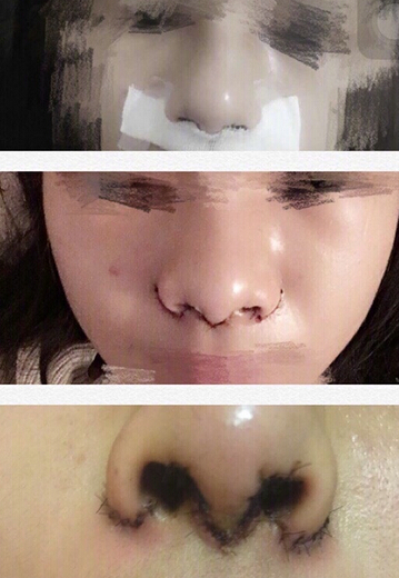 工作室做的耳软骨垫鼻尖,假体隆鼻和鼻翼缩小