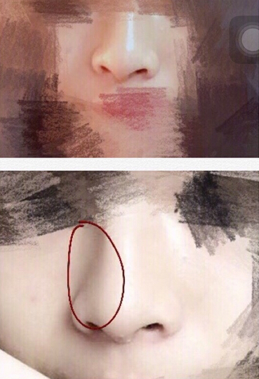 工作室做的耳软骨垫鼻尖,假体隆鼻和鼻翼缩小