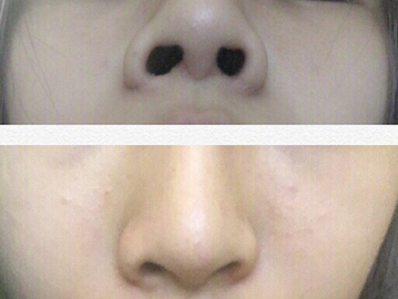 工作室做的耳软骨垫鼻尖,假体隆鼻和鼻翼缩小