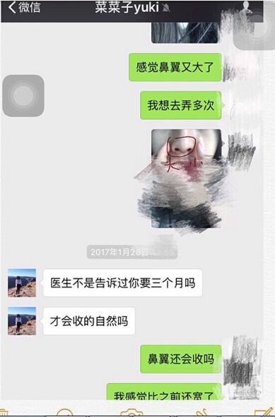 工作室做的耳软骨垫鼻尖,假体隆鼻和鼻翼缩小