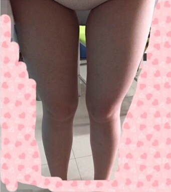 西安美好美容医院做的大腿环吸手术
