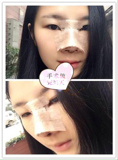 长沙协雅医疗美容邹笑寒做的膨体鼻部手术