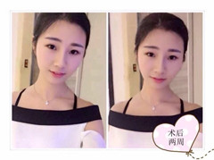 长沙协雅医疗美容邹笑寒做的膨体鼻部手术