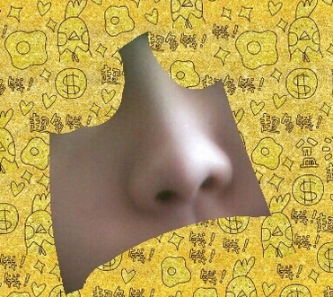 中日友好医院曾高医生做的膨体鼻部手术案例