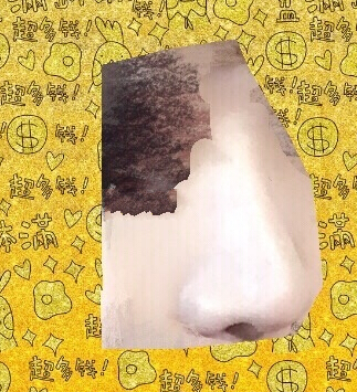 中日友好医院曾高医生做的膨体鼻部手术案例