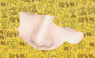 中日友好医院曾高医生做的膨体鼻部手术案例