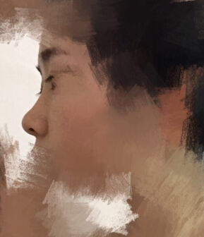 重庆毕胜医生处做的鼻部手术整形手术案例