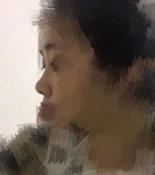 重庆毕胜医生处做的鼻部手术整形手术案例