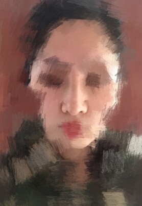 重庆毕胜医生处做的鼻部手术整形手术案例