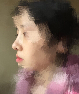 重庆毕胜医生处做的鼻部手术整形手术案例
