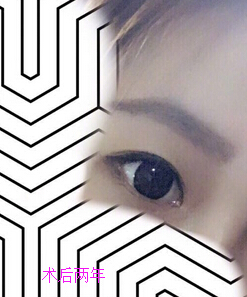 【分享经验】做了眼部手术和鼻部手术手术