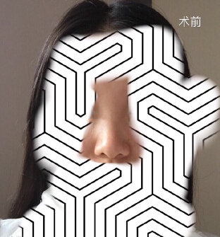 【分享经验】做了眼部手术和鼻部手术手术